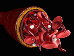anemia infantil 1 3