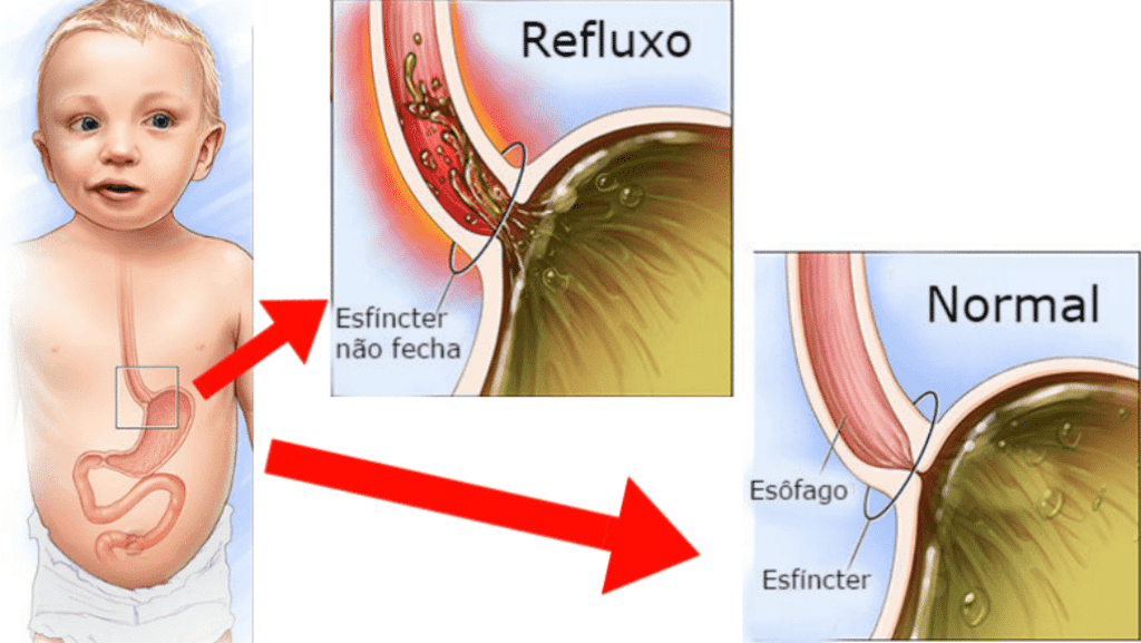 O Que É Refluxo No Bebê